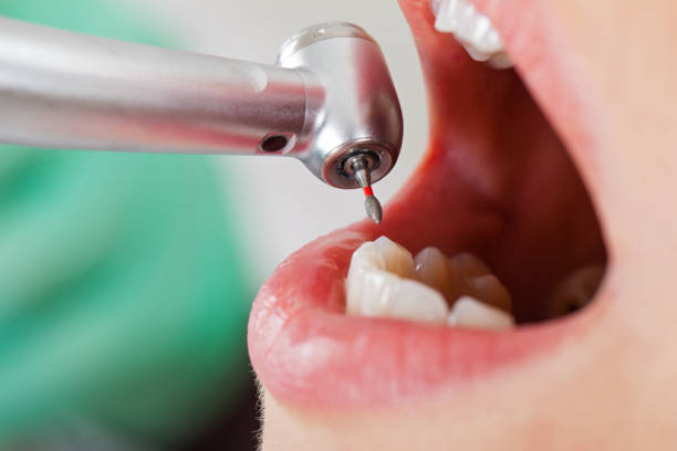 Best Emergency Tooth Extraction in East Syracuse, NY
